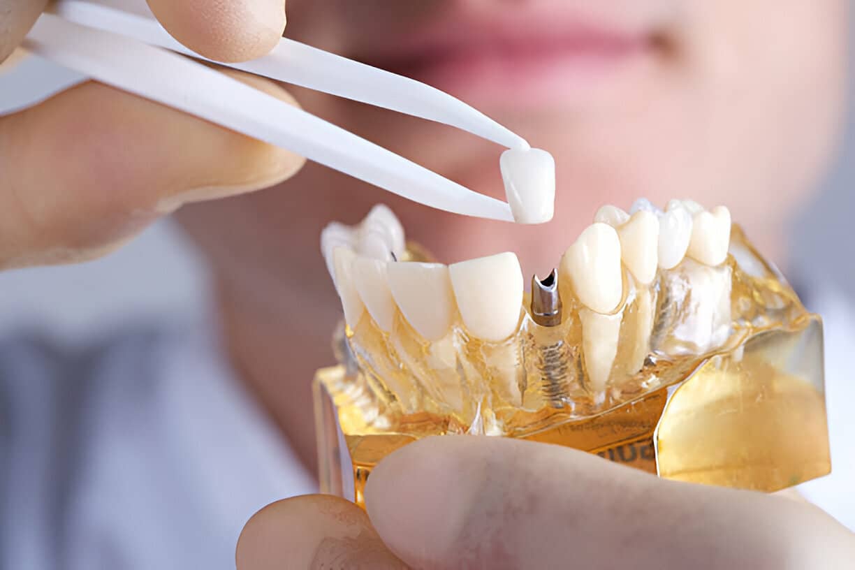 Learn what to expect before, during, and after dental implants. Discover how Team Roncesvalles Dentistry can restore your smile with expert care.
